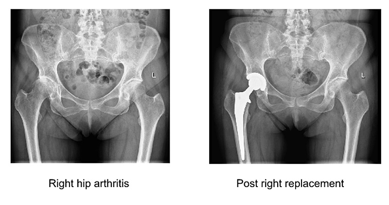 image of arthritic hip and same hip with a total hip replacement